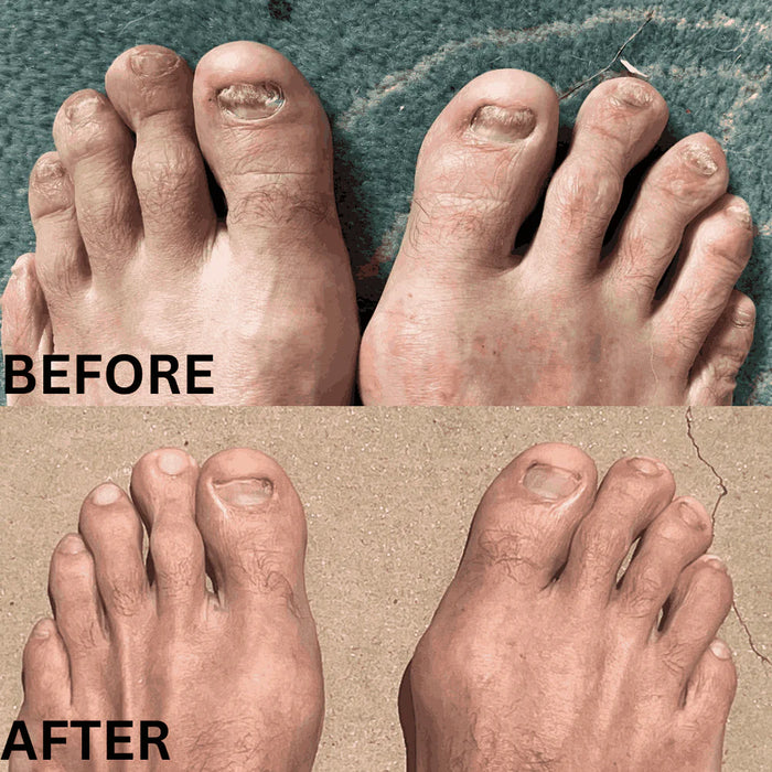 Gabri - Antifungal Device